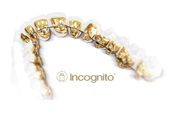 Incognito™ Braces Image